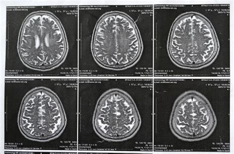 Picture of a brain hemorrhage stroke — Stock Photo © YuliyaM #66894407