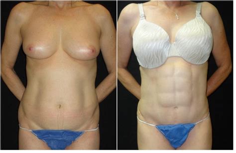 Abdominal Etching Before And After Photos In Fairfax VA