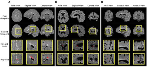 Frontiers New Lesion Segmentation For Multiple Sclerosis Brain Images