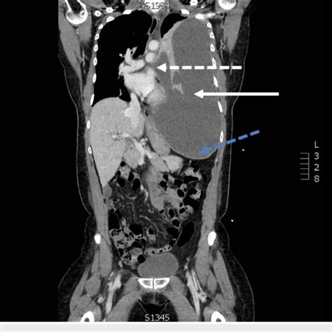 A Coronal Slice Of A Contrasted Computed Tomography Of The Chest