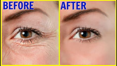 Remove Wrinkles 3 In 1 Forehead Wrinkles Eye And Smile Wrinkles Anti