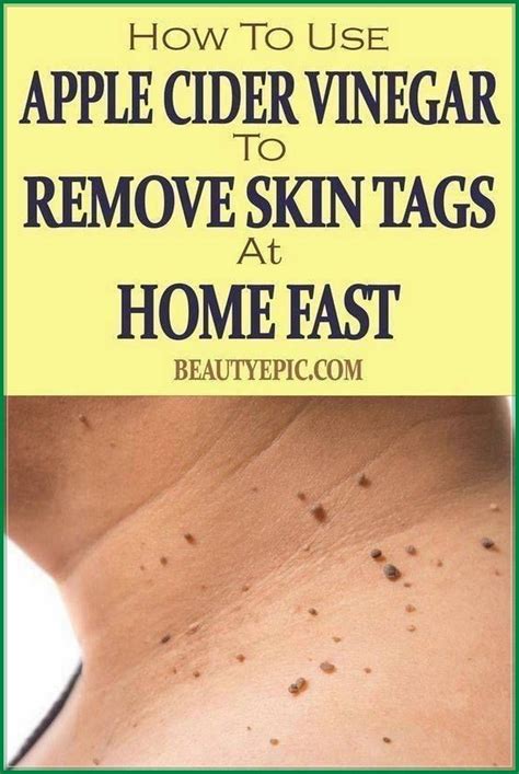 How To Remove Skin Tag In 1 Night Molluscum Pendulum Remove Skin Tags Naturally Apple Cider