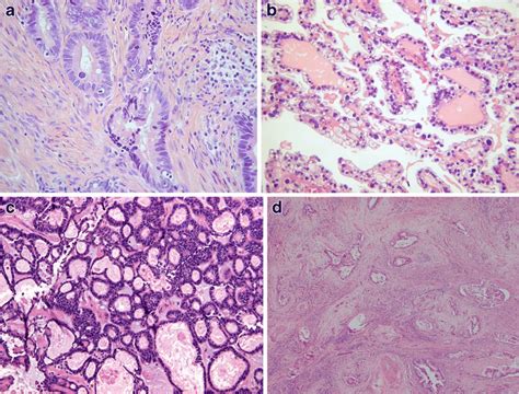 Various Histological Types Of Adenocarcinoma A Endocervical