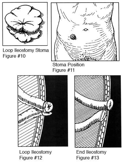 Ileostomy Diagram