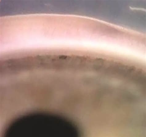 Primary Congenital Glaucoma