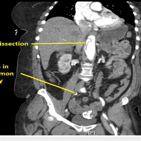 Ct Scan Showing Dissection At Aortic Root Download Scientific Diagram