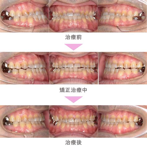 インビザライン矯正（マウスピース矯正）の症例紹介｜受け口（反対咬合）と交叉咬合（すれ違い）の症状｜非抜歯による矯正治療｜治療期間は2年8ヵ月