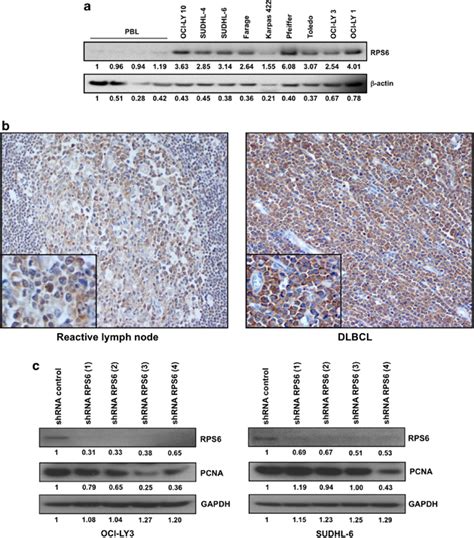 Rps Is Overexpressed In Dlbcl And Shrna Knockdown Of Rps Resulted In