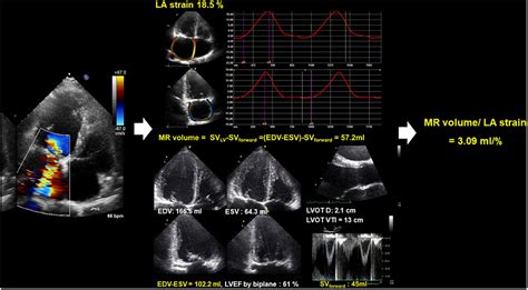 Frontiers Left Atrial Strain And Clinical Outcome In Patients With