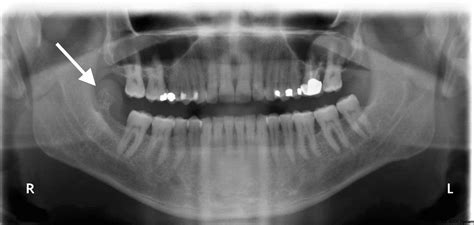 Peripheral Ossifying Fibroma Radiograph