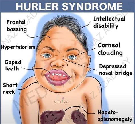 Mucopolysaccharidosis Type I Hurler Syndrome Symptoms 40 Off