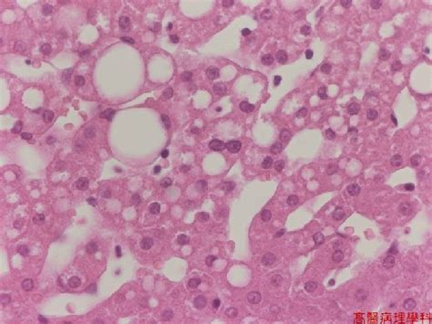 KMU Pathology LabSlide 7 Fatty Liver Liver