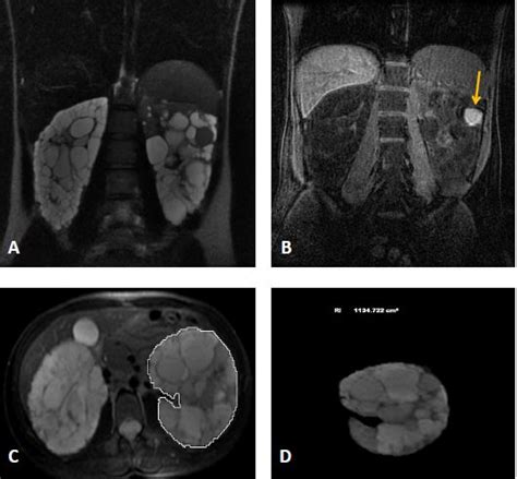 PatologÍa Vascular Y QuÍstica Intracraneal En La Poliquistosis Renal