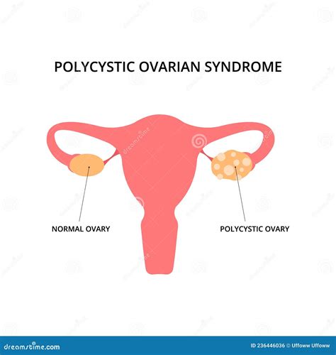 Polycystic Ovarian Syndrome Stock Vector Illustration Of Inside