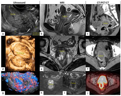 Cervical Incompetence Imaging Overview Magnetic Resonance Imaging