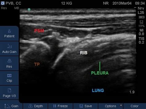 Fig 9 Transverse Plane Mid Thoracic Level Psm Paraspinal Muscles