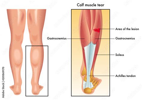 vector medical illustration of the symptoms of calf muscle tear Stock ...