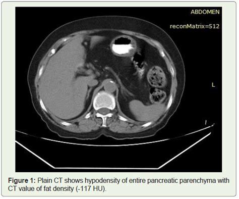 CT MRI Findings In A Rare Case Of Total Fat Replacement Of Pancreas