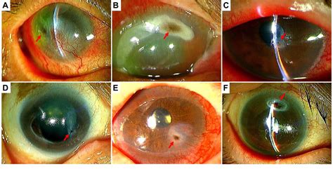 Figure 1 from Lacrimal Duct Obstruction and Infection Associated with ...