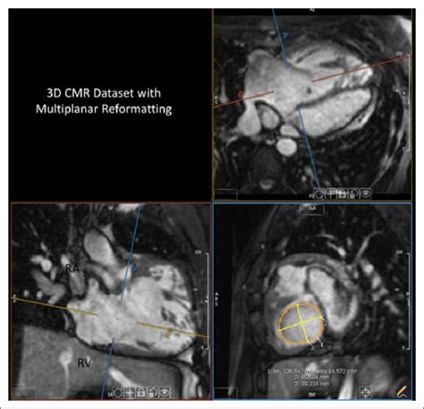 Three Dimensional Whole Heart Cardiac Magnetic Resonance Data Set With