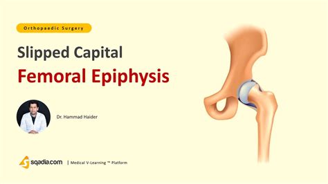 Slipped Capital Femoral Epiphysis