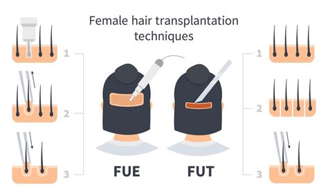 여성 모발 이식 Fue 및 Fut 인포그래픽 프리미엄 벡터