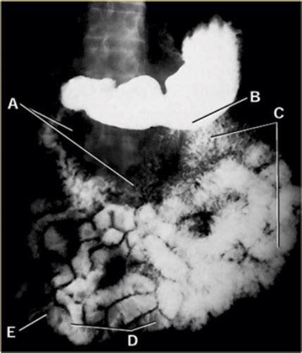 Small Bowel Lower Gastrointestinal System Anatomy Flashcards Quizlet