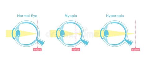 Myopia Hyperopia And Astigmatism Common Vision Disorders And Its