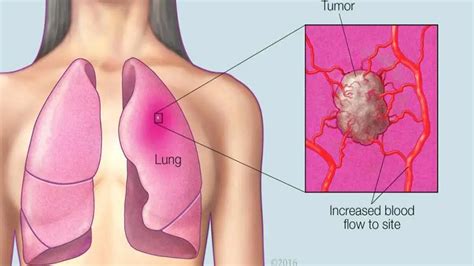 Lung Cancer Causes Symptoms Treatment And Prevention