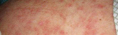 Heat Rash In Groin Area Female