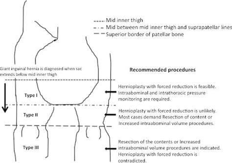 Giant Inguinal Hernia Repair Using Standard Transverse Inguinal