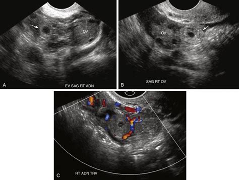 Ectopic Pregnancy Radiology Key