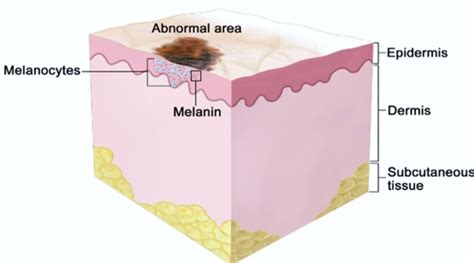 What Is Melanoma Creative Diagnostics