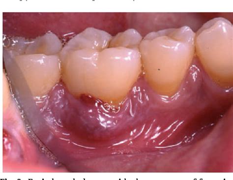 Figure From Acute Periodontal Lesions Semantic Scholar