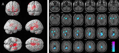 Areas With Decreased Regional Cerebral Blood Flow In Ftd Patients With