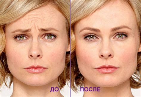 Ботокс