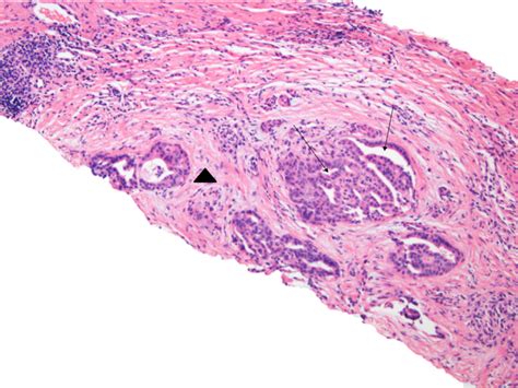 Pathology Pearls Intrahepatic Cholangiocarcinoma Aasld