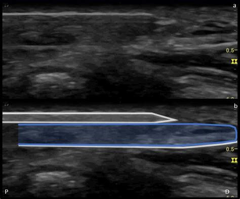 Ultrasound Guided Minimally Invasive Cubital Tunnel Thread Release An