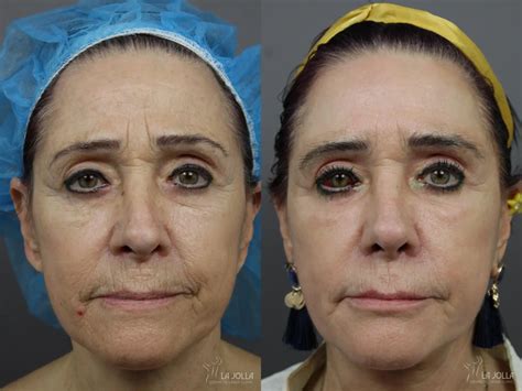 Sculptra® Before And After Gallery Patient 8