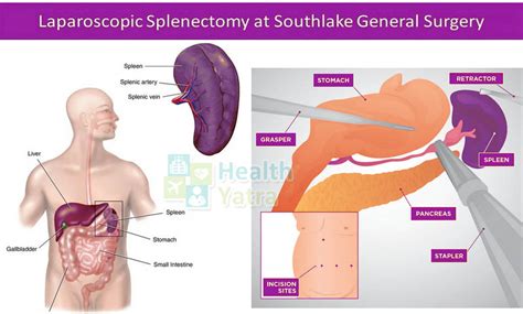 Advanced and Affordable Splenectomy in India - Updated 2023