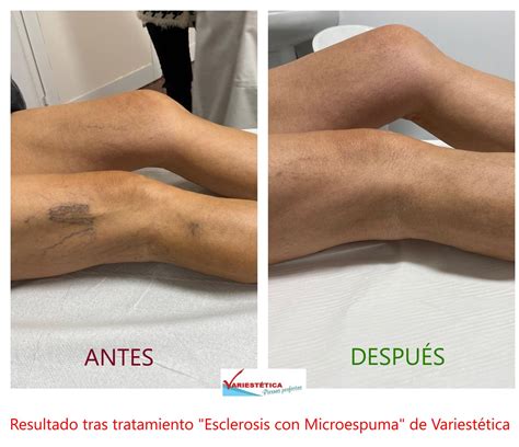 Esclerosis de varices con microespuma Eliminar varices Málaga