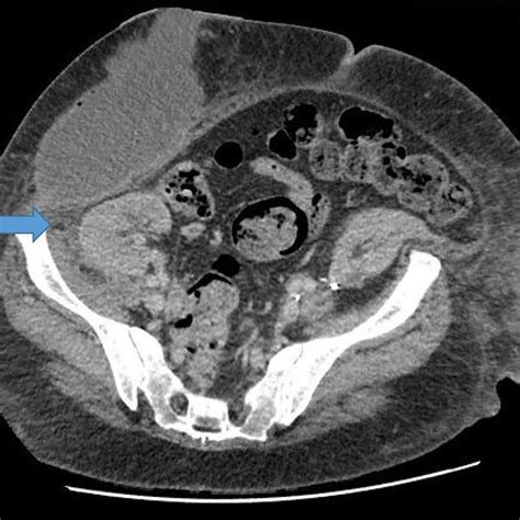 Large Right Retroperitoneal Loculated Fluid Collection Superior To The