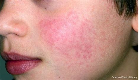 Rashes And Spots In Children With Pictures Page 9