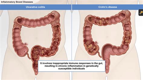 Understanding Ulcerative Colitis A D A M Ondemand