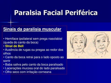 Ppt Paralisia Facial Powerpoint Presentation Id