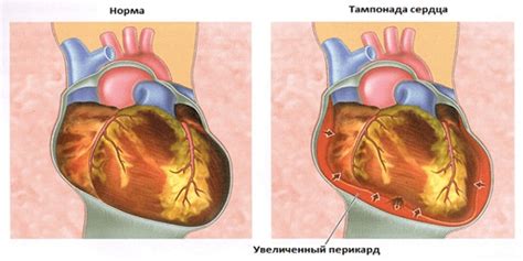 Pericarditis traumática por qué y síntomas ocurren tratamiento del ganado