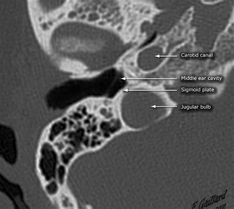 High Riding Jugular Bulb Radiology Medical Radiography Jugular