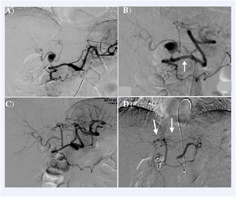 Figure From Successful Management Of A Proper Hepatic Artery Aneurysm