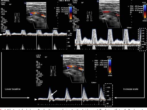 Figure 6 From Doppler Ultrasonography Of The Lower Extremity Arteries