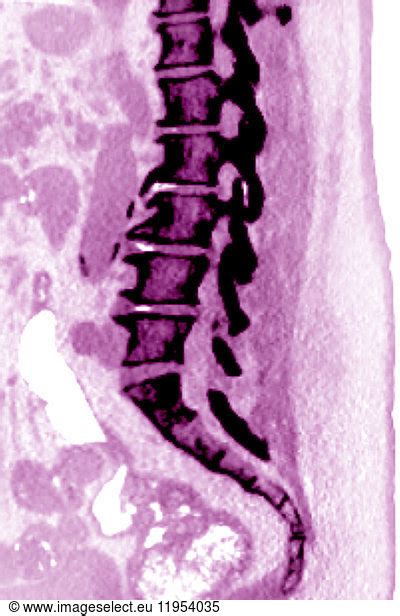 Vertebral Osteoarthritis With Osteophytes Bone Spurs Seen On A